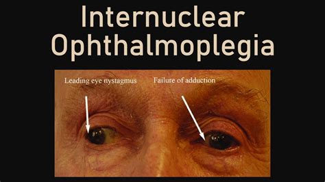 Internuclear Ophthalmoplegia