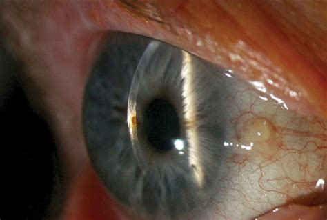 Corneal Rust Ring