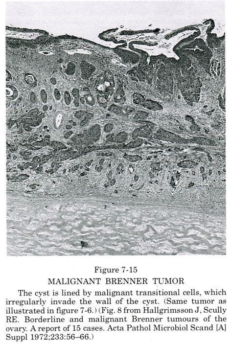 Pathology Outlines - Malignant Brenner tumor