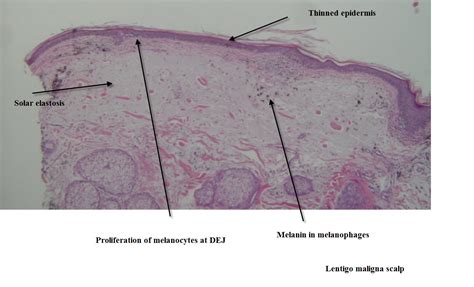 Dermpath Made Simple - Neoplastic: Lentigo Maligna