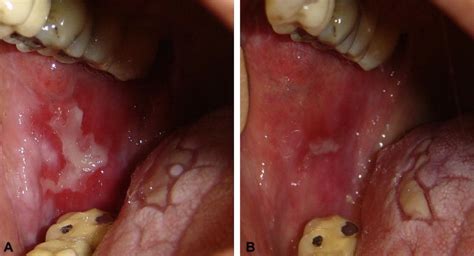 Treatment of erosive oral lichen planus with local ultraviolet B ...