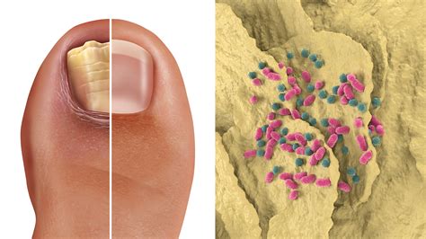 Dermatologists Explain the Causes of Fingernail Fungus (and How to Fix it) | Power of Positivity ...