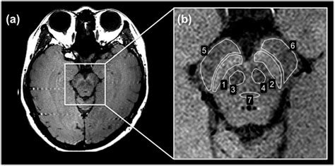 Neuromelanin-sensitive MRI identified as a potential biomarker for ...