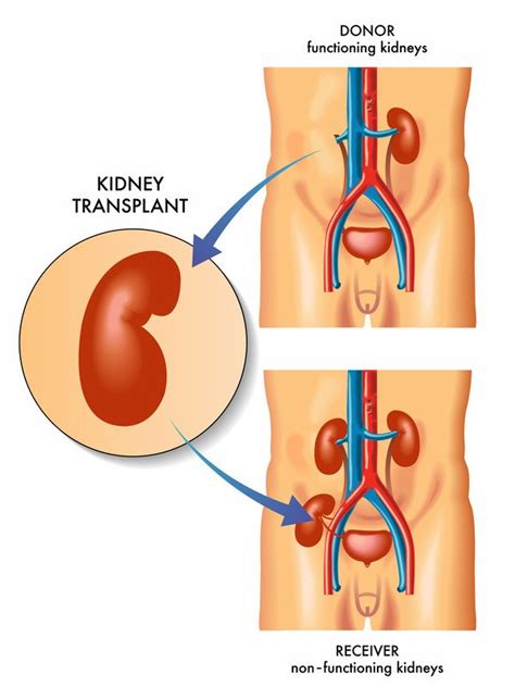 Kidney Transplant Guide