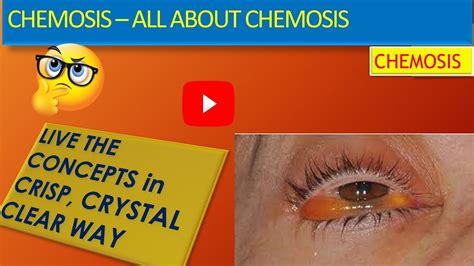 CHEMOSIS- ALL ABOUT CHEMOSIS, What is chemosis? Causes of Chemosis? Treatment of Chemosis? - YouTube