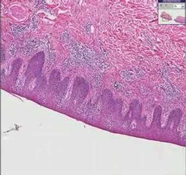 Histopathology Skin--Parapsoriasis - YouTube