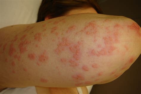 dermatitis herpetiformis pictures - pictures, photos