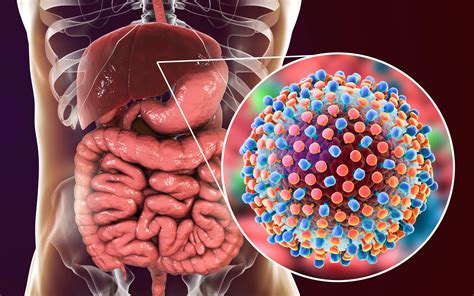 Managing Hepatitis C in Treatment-Naïve Patients With HIV