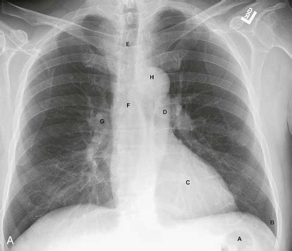 The Normal Chest X-Ray: Reading Like the Pros | Radiology Key