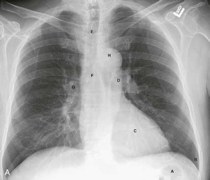 The Normal Chest X-Ray: Reading Like the Pros | Radiology Key