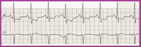 Float Nurse: Practice EKG Rhythm Strips 216