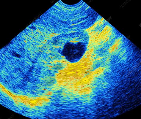 Kidney cyst, ultrasound scan - Stock Image - M195/0101 - Science Photo Library