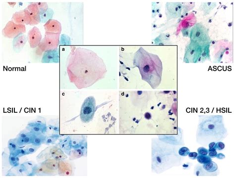 ASCUS PAP Smear & HPV - Anthony Siow