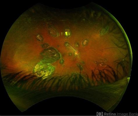 Idiopathic multifocal choroiditis (IMFC) - Retina Image Bank