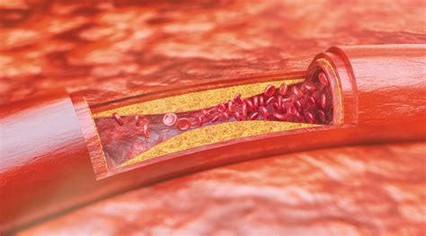 Avoiding atherosclerosis: The killer you can't see - Harvard Health