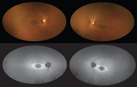 Retinitis pigmentosa - American Academy of Ophthalmology