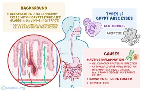 Crypt Abscess: What Is It, Causes, Diagnosis, and More | Osmosis