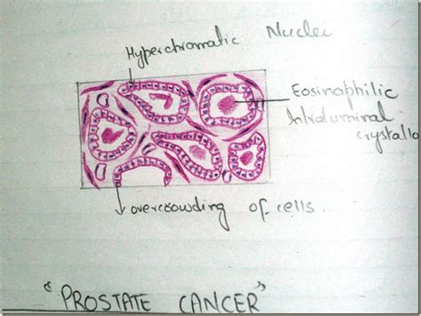 Histology Slides Database: CA prostate histopathology diagram