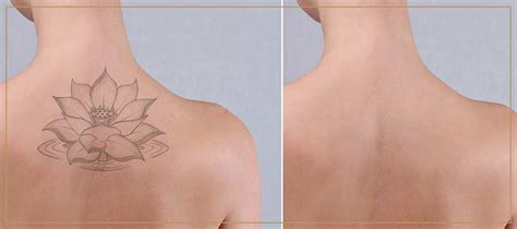 Laser Tattoo Removal Near Me in Oakbrook Terrace, IL