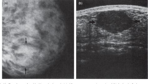 [PDF] Ultrasound diagnosis of breast cancer | Semantic Scholar