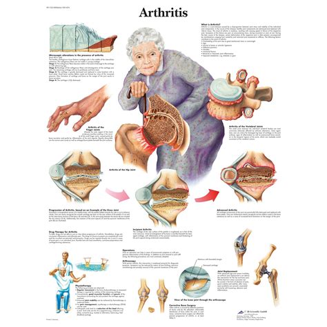 3B Scientific Arthritis Chart