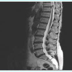 MRI T2 weighted images showing the presence of Tarlov cyst at S2/3 ...