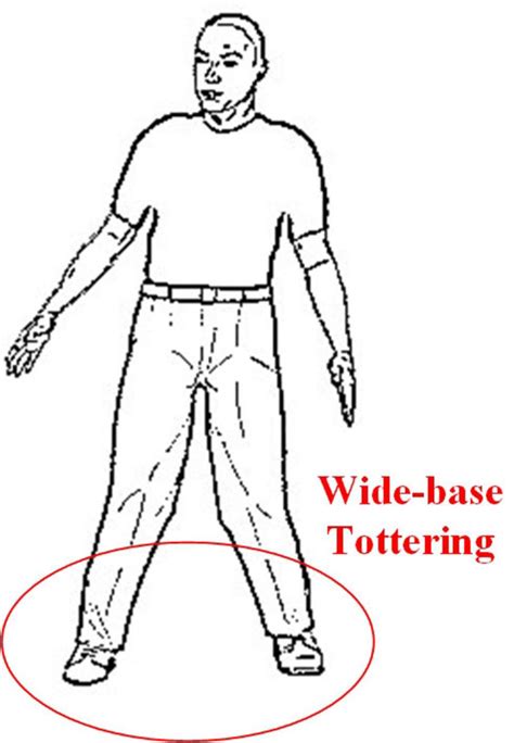 | Cerebellar ataxia Gait. | Download Scientific Diagram