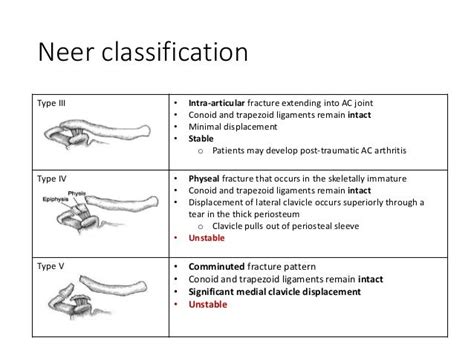 Classification Of Clavicle Fracture