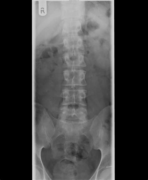 Lumbar Vertebrae X Ray