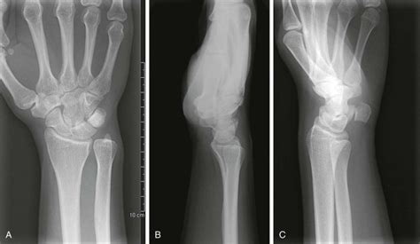 Ulnar Deviation X Ray