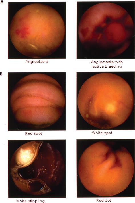 Capsule Endoscopy Versus Push Enteroscopy for Evaluation of Obscure ...