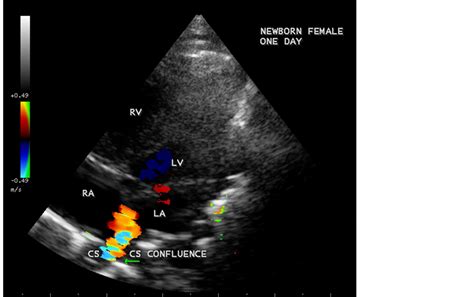 Coronary Sinus Atrial Septal Defect (Unroofed Coronary Sinus) with ...