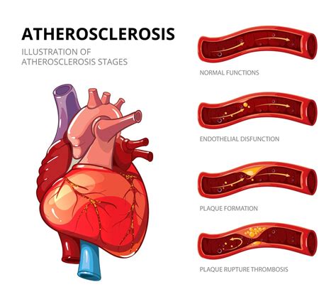 Atherosclerosis Symptoms: Frequently Asked Questions