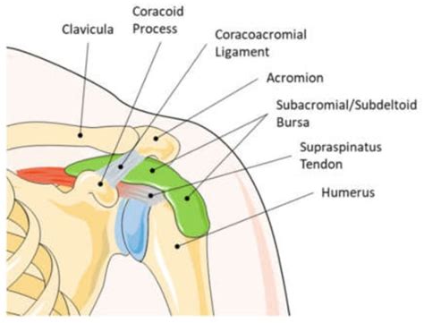 Subdeltoid Bursitis