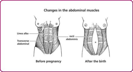 Divarication of Abdominal Muscles | North Bristol NHS Trust