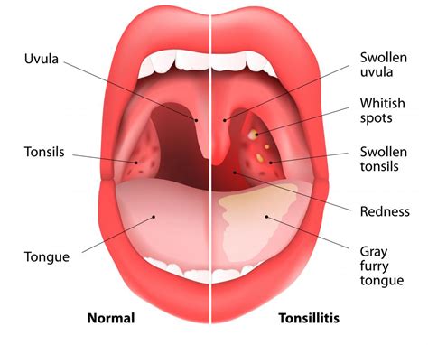 What Are the Most Common Causes of Throat Swelling?