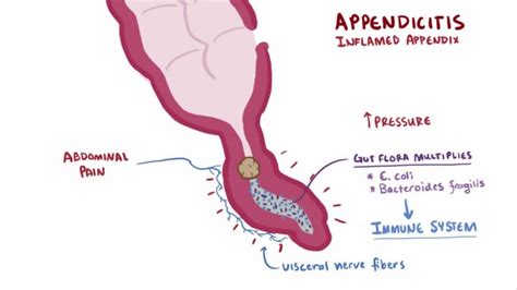 Appendicitis | Getcured Apothecary Pvt Ltd