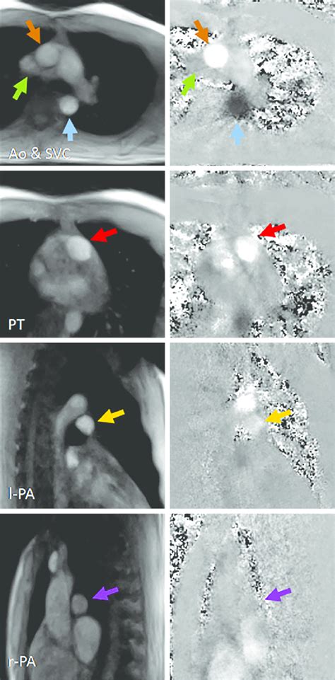 Real-time phase-contrast flow MRI (3 T, 40 ms): magnitude images and... | Download Scientific ...