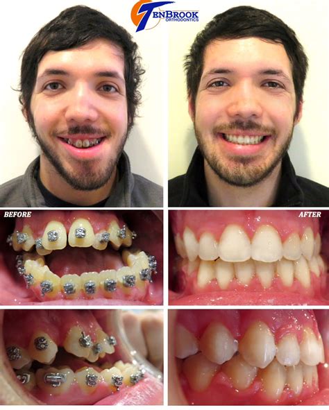 TenBrook Orthodontics on Twitter: " ️Jack had trauma to his jaw as a child. He came to us with a ...