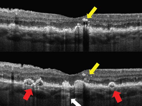 OCT: An Indispensable Tool in Retina Care