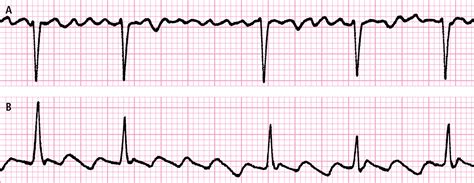 Electrocardiograma estándar - Electrocardiografía - Pruebas funcionales ...