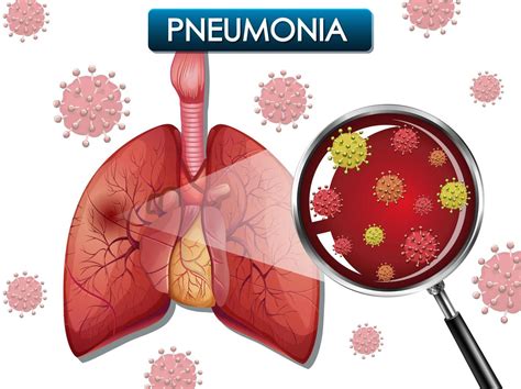 Pneumonia poster with lungs and virus cells 1142230 Vector Art at Vecteezy