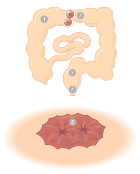 Ileostomy - AINSCORP