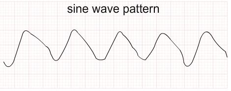 Hyperkalemia ECG Changes Mnemonic [With ECG Strips]