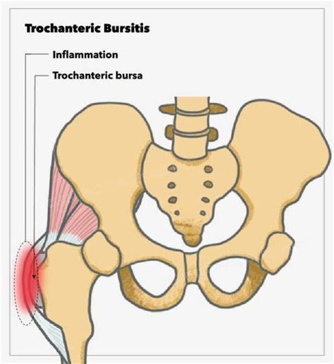 Greater Trochanteric Bursa Injection | Treatment & Management | Point of Care