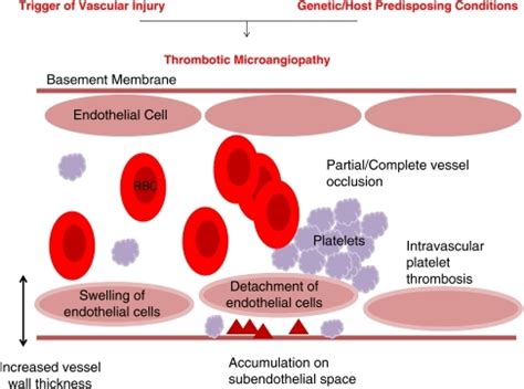 Thrombotic microangiopathy: “the final events”. Thr | Open-i