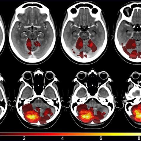 Lesion overlap for the cerebellar patient group (n=14). The regions of... | Download Scientific ...