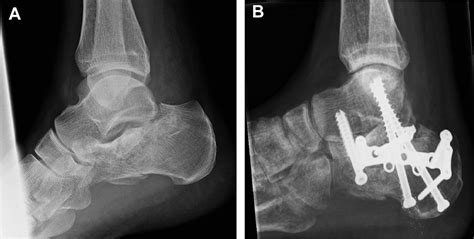 Primary subtalar arthrodesis following reconstruction via ELA. (A)... | Download Scientific Diagram