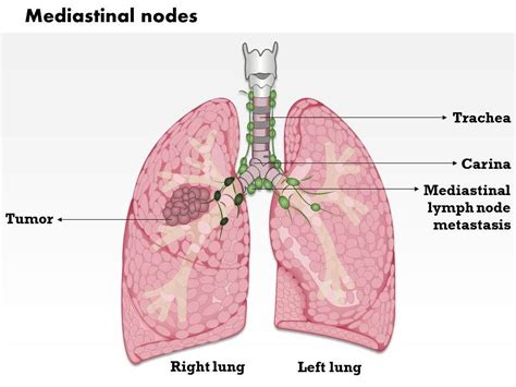 Hilar Lymph Nodes Lung Cancer