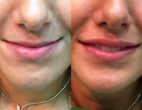 Before and after lips injected with hyaluronic acid Revanesse ultra ...